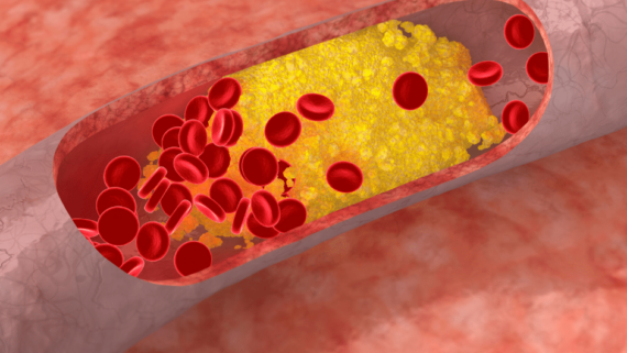 L'excés de colesterol pot acumular-se a les parets de les artèries, formant plaques que les fan més estretes i menys flexibles.