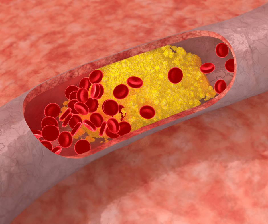 L'excés de colesterol pot acumular-se a les parets de les artèries, formant plaques que les fan més estretes i menys flexibles.